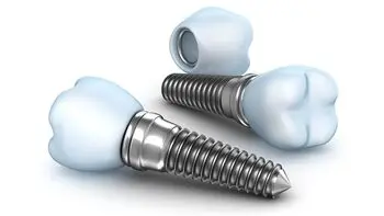 Dental_Implant