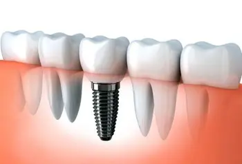 Dental Implant