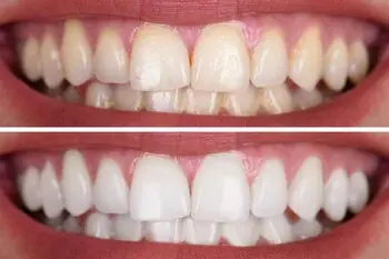 teeth_whitening